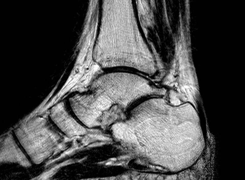 ankle mri